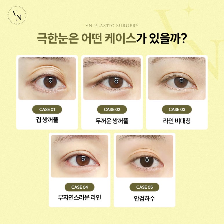 Is Surgery for Extremely Difficult Eyes Possible? image 3