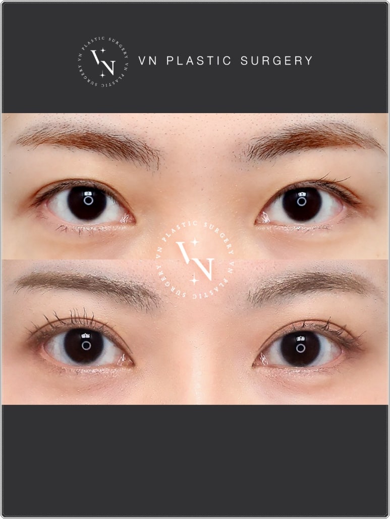 VN Plastic Surgery: If the Inline Looked Too Constricted and the Outline Felt Too Dramatic image 8