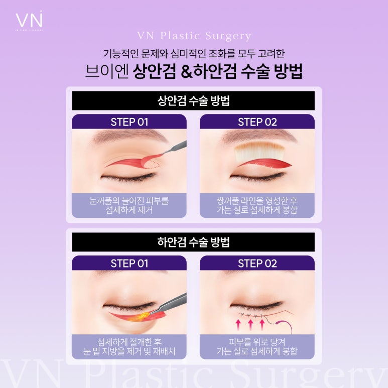 상안검이랑 하안검 동시에 수술받을 수 있나요? 관련 이미지 3