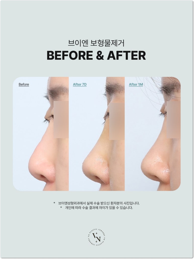 브이엔성형외과 코보형물제거 비용과 수술 후 코 모양 변화 관련 이미지 4