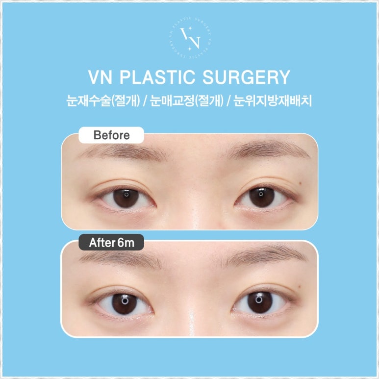 How Eyelid Correction Changes the Eyes: Comparison of Incision and Non-Incision Methods and Recovery Time image 6
