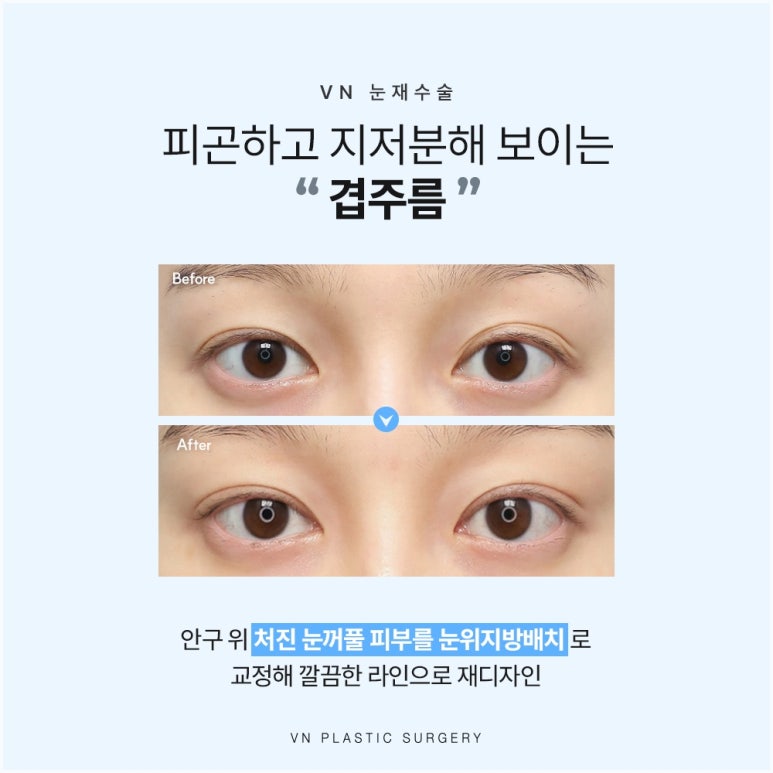눈재수술성형외과, 원인부터 다르게 봐야 하는 이유 관련 이미지 4