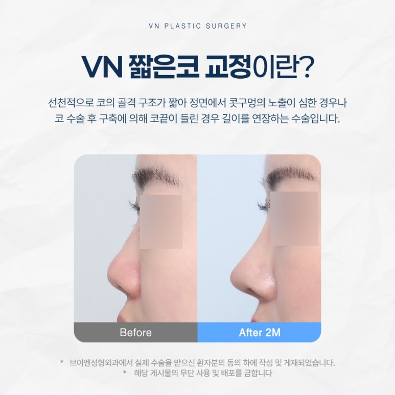 Short Nose Surgery at a Plastic Surgery Clinic in Sinnonhyeon: Key Points for Restoring Facial Proportions image 2