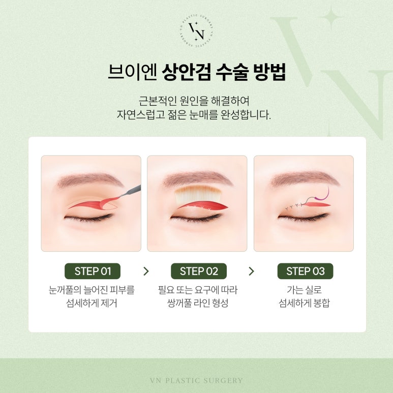 Vn Plastic Surgery: What Is the Solution to Concerns About Drooping Upper Eyelids? image 4