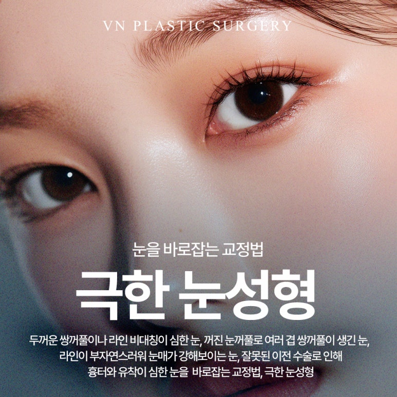[강남/신논현 브이엔성형외과] 극한눈성형, 다시 찾는 자연스러운 눈매 관련 이미지 3
