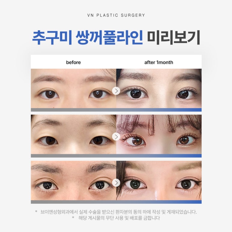 수험생만을 위한 특별한 눈성형 혜택, [브이엔성형외과, 수능눈성형] 관련 이미지 2