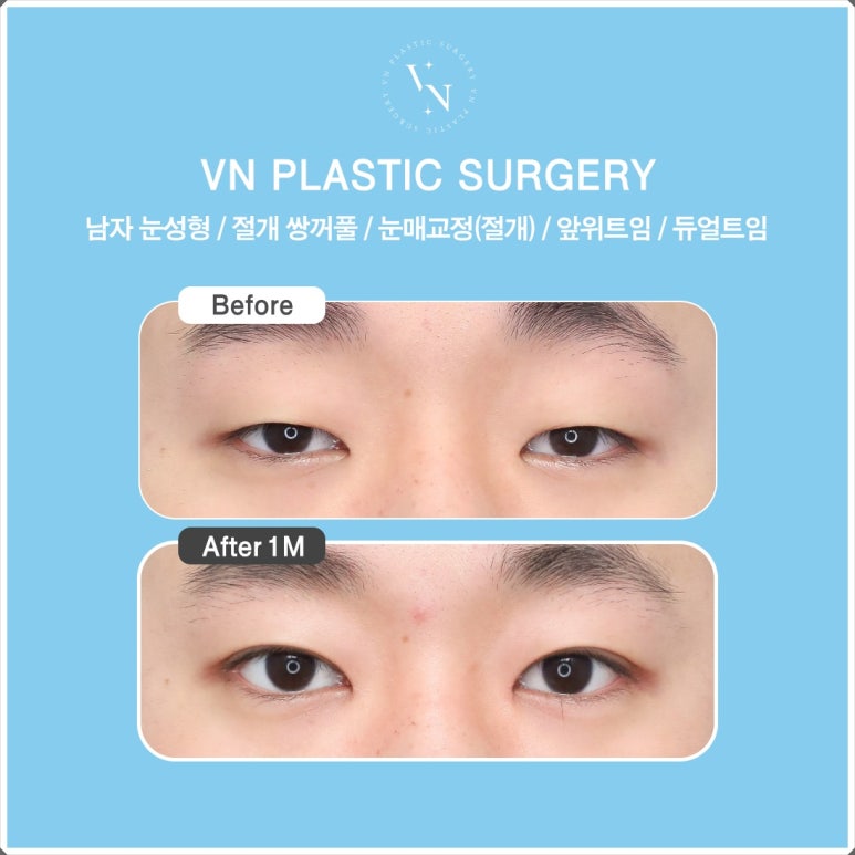 Male Eye Surgery: The Difference in Details That Create a Natural Eye Shape image 8