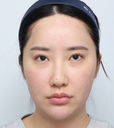 외모 고민 해결 기회✨ 브이엔성형외과 모델 모집! 관련 이미지 7