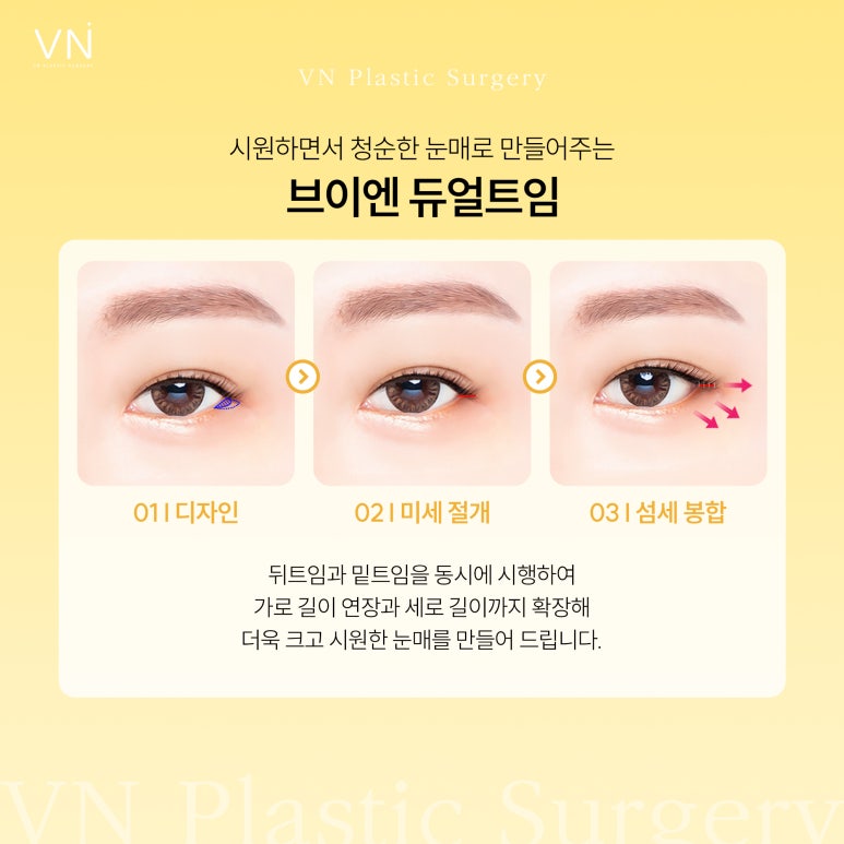 트임성형, 과하지 않고 자연스럽게 개선하는것이 포인트 관련 이미지 5