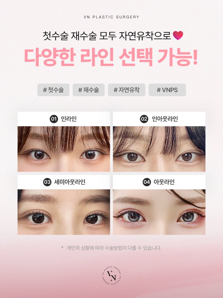 눈성형외과유명한곳, 브이엔성형외과에서 내게 맞는 라인 찾기 관련 이미지 2