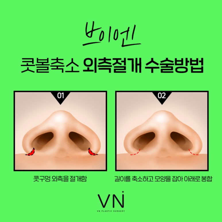 Let’s Get Rid of the Bulbous Nose! Learn About Nostril Reduction Surgery image 6