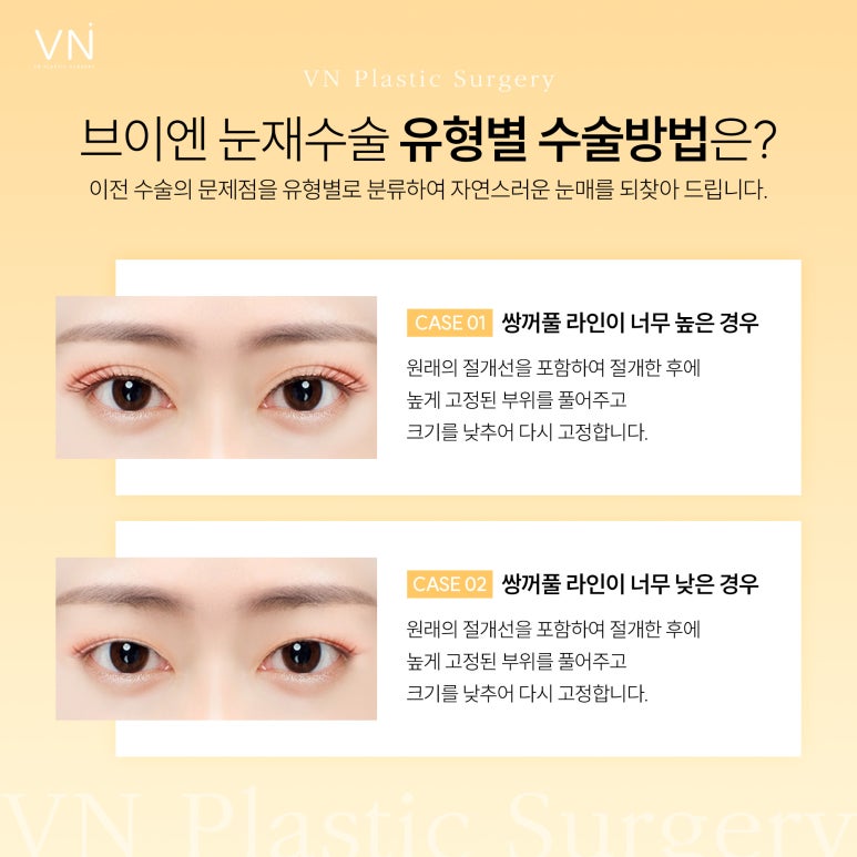 Revision Eyelid Surgery: How Can It Be the Last Surgery? image 3