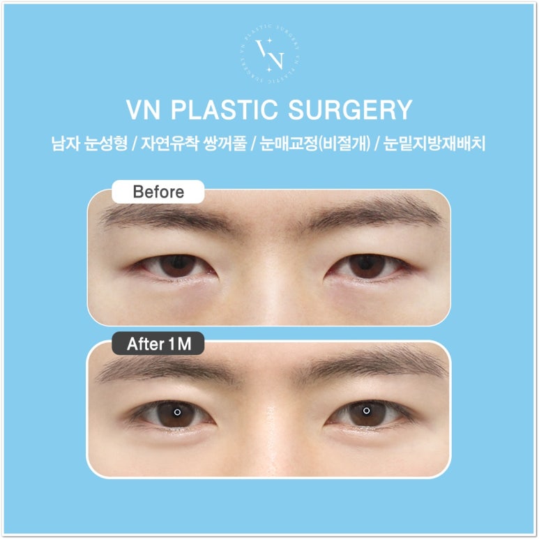 Best Place for Lower Eyelid Fat Repositioning: Should You Always Remove Lower Eyelid Fat? image 4