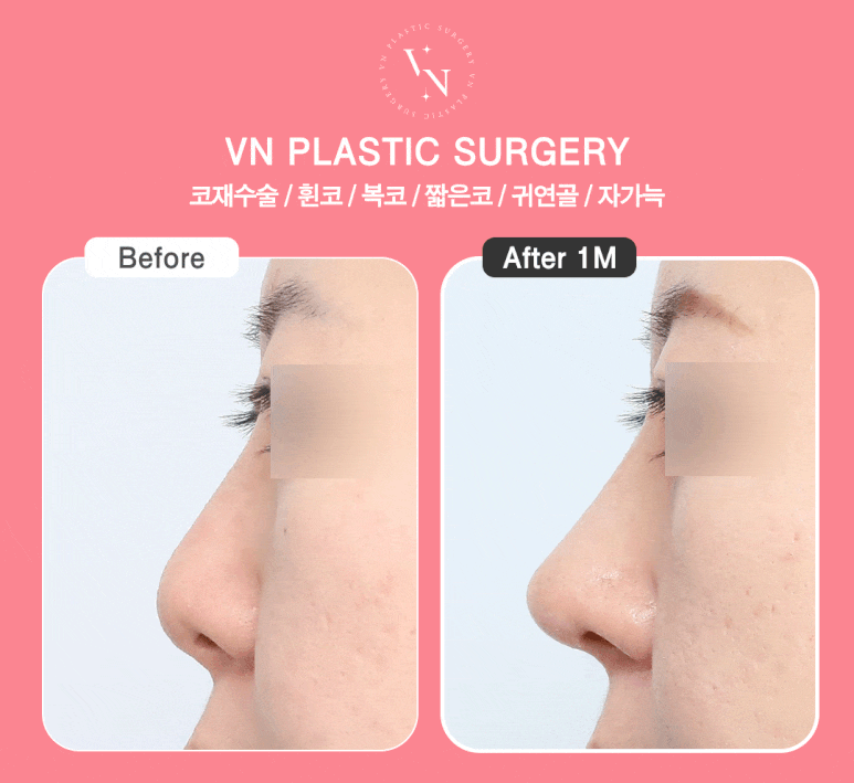 [Gangnam/Sinnonhyeon VN Plastic Surgery] Autologous Rib Cartilage Surgery: Rhinoplasty Tips to Reduce Pain and Recovery Concerns image 5