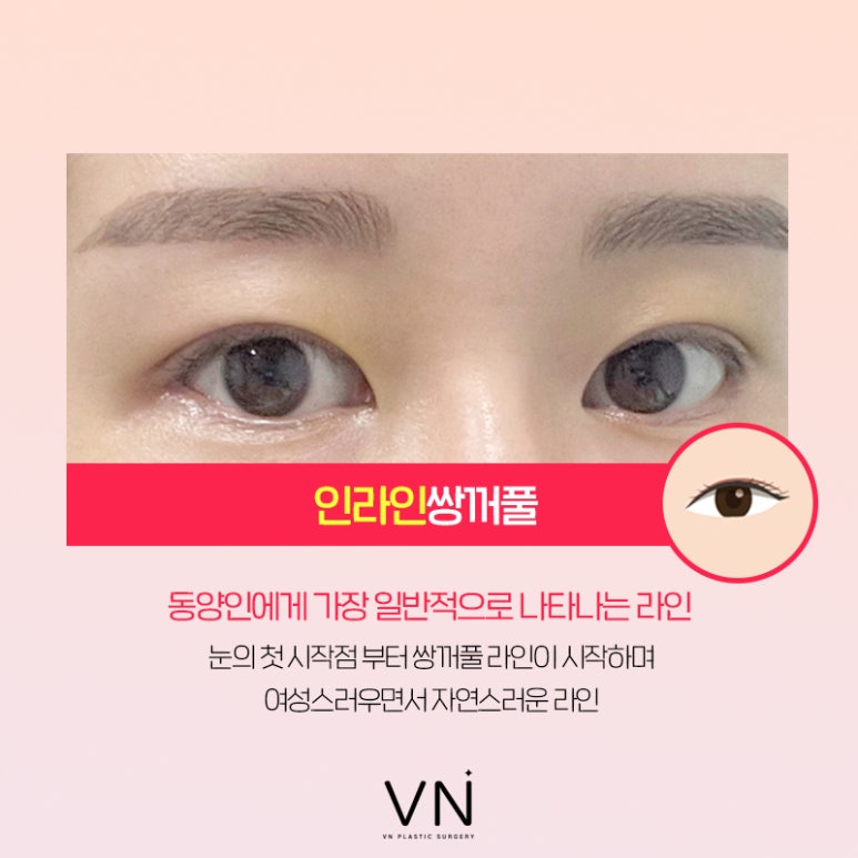 인라인? 아웃라인? 쌍꺼풀수술라인 종류 알아보기 (+연예인 쌍꺼풀) 관련 이미지 3