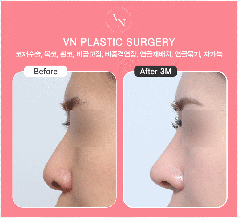 자가늑 코수술 통증과 회복 기간, 늑연골 채취 후 주의 사항까지 관련 이미지 4