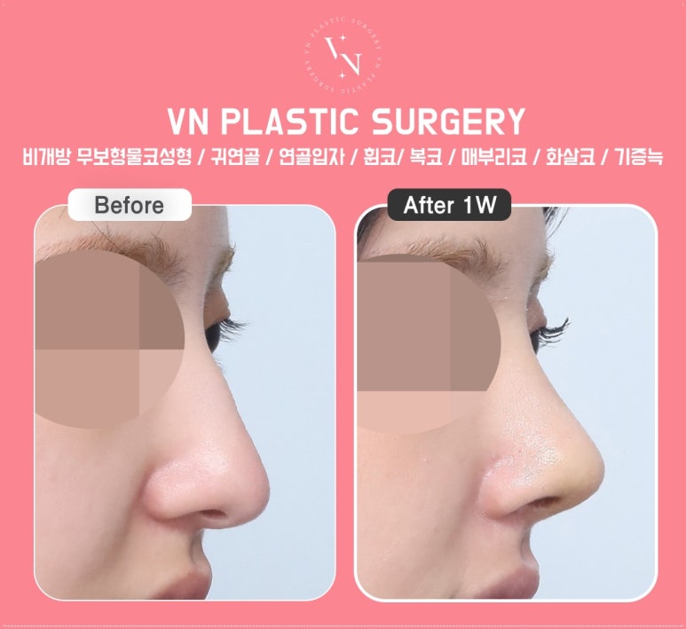 Looking for a Clinic for Natural-Looking Rhinoplasty? ShashaCo at VN Plastic Surgery Clinic image 10