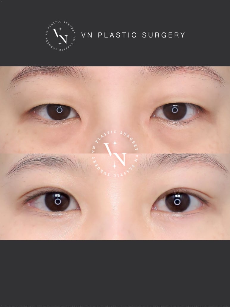 VN Plastic Surgery Lower Blepharoplasty vs. Lower Eyelid Fat Repositioning: Which Is Right for Me? image 6