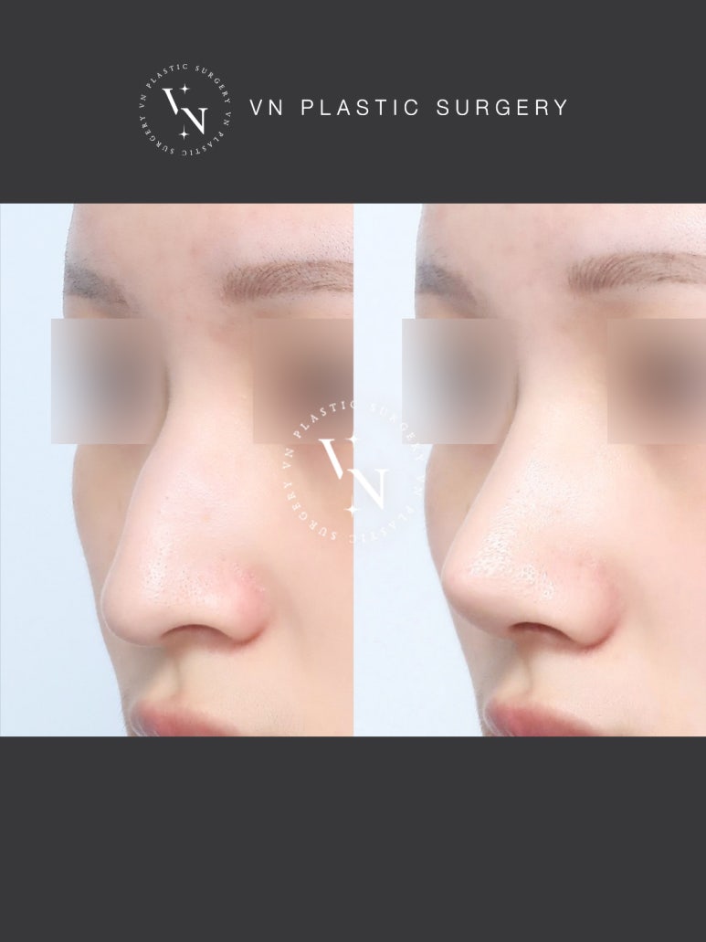 [Sinnonhyeon Plastic Surgery] If Your Hump Nose Is Stressing You Out, Be Sure to Read This image 7