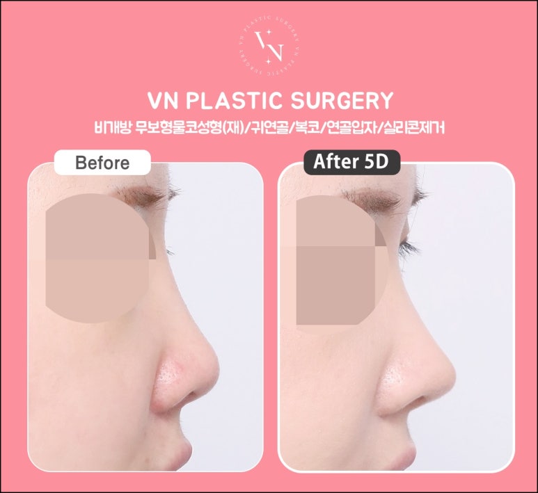 VN Plastic Surgery: When Closed Revision Rhinoplasty Is Possible (Side Effects / Contour / Nasal Tip) image 4