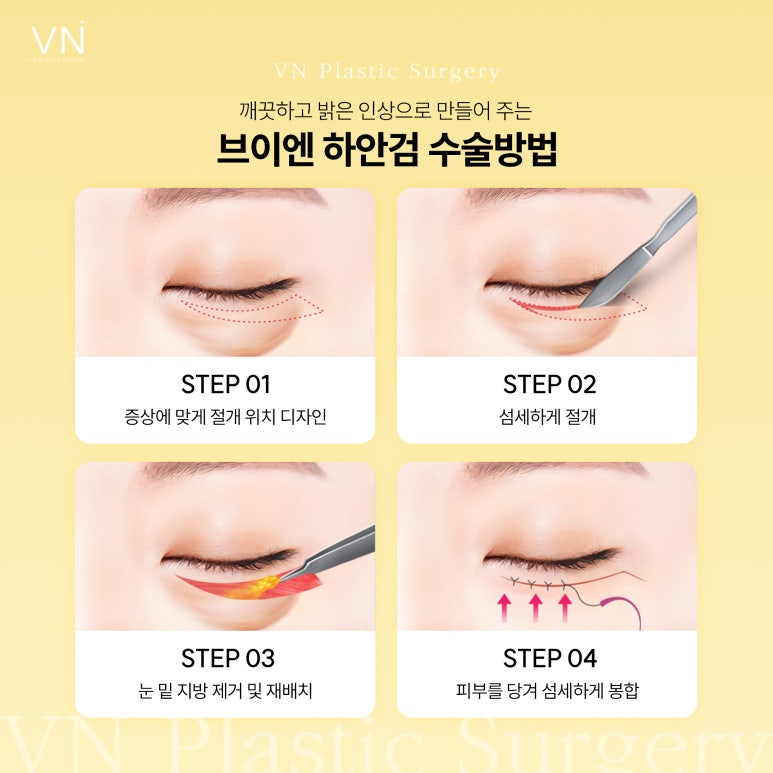 Upper Eyelid Surgery? Lower Eyelid Surgery? A Comparative Analysis of Eyelid Surgery for Middle-Aged Adults image 4