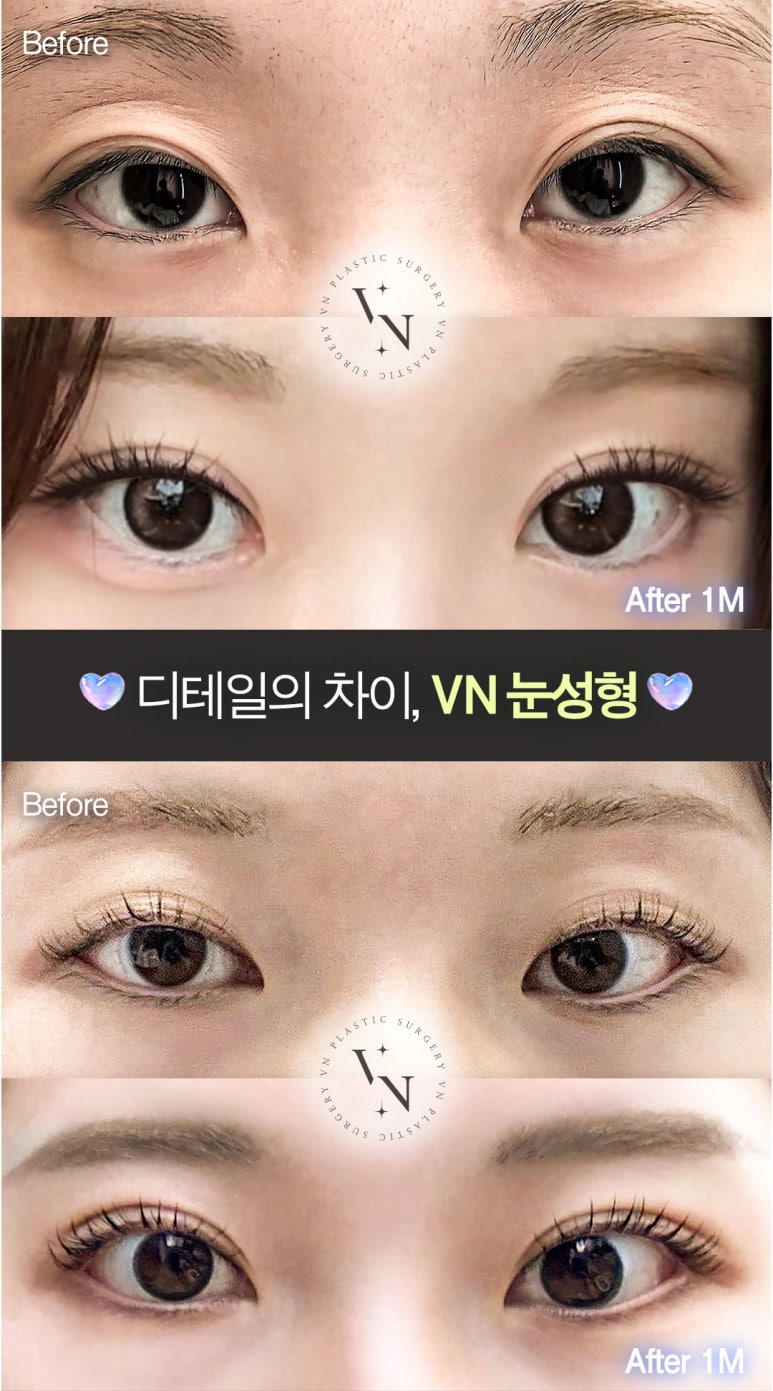 VN Plastic Surgery College Entrance Exam Eye Surgery Event πβ¨ image 3