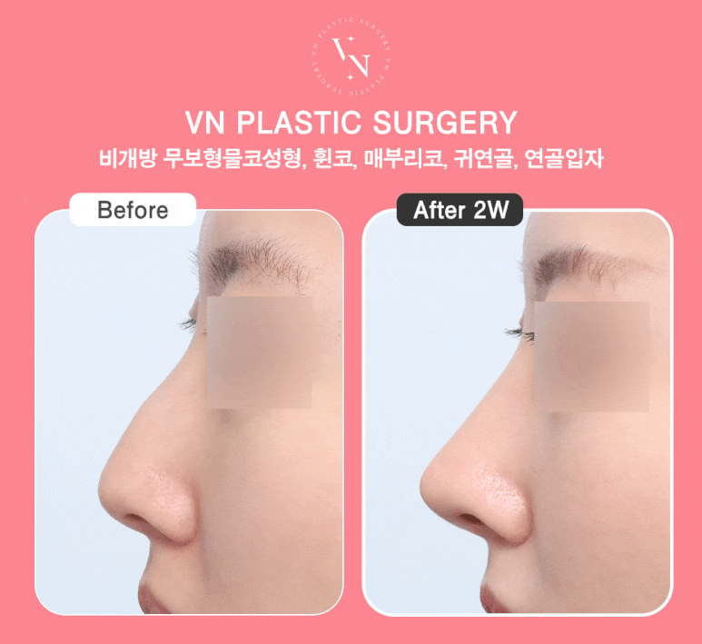 Thinking About Non-Open Nose Surgery? Find the Answer with ShashaKo at VN Plastic Surgery image 7