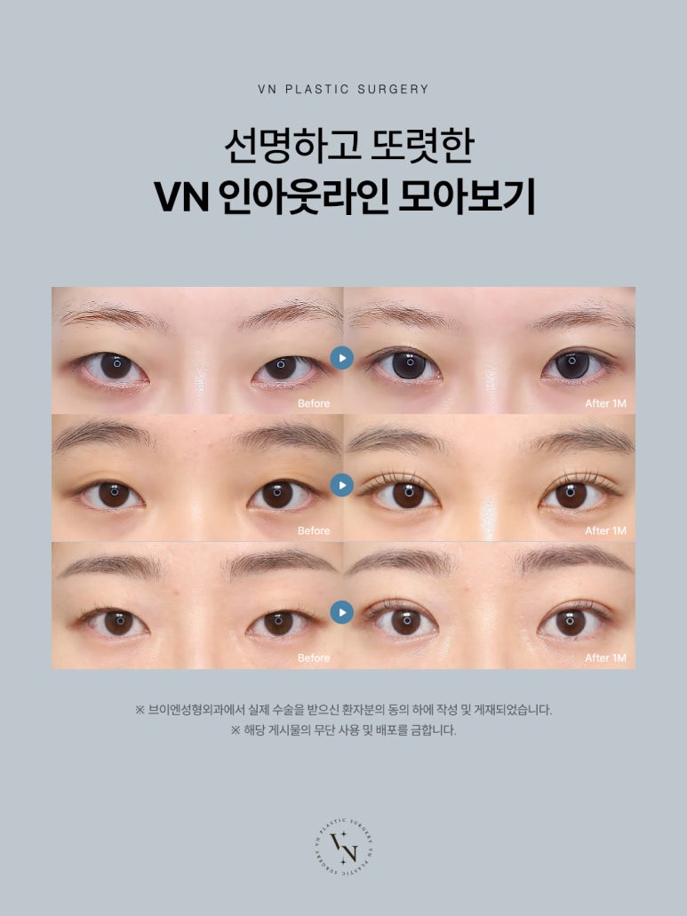 Shinnonhyeon Plastic Surgery Eye Surgery Trend: Why the In-Out Line Is Getting Attention image 3