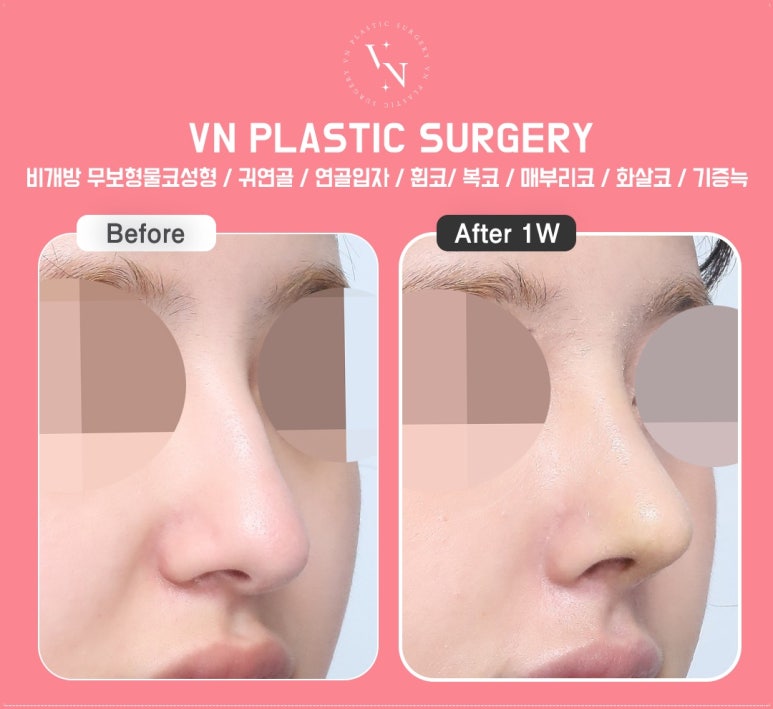 Looking for a Clinic for Natural-Looking Rhinoplasty? ShashaCo at VN Plastic Surgery Clinic image 11
