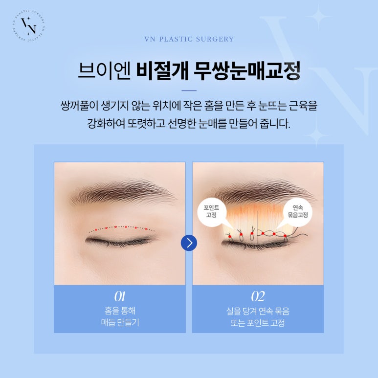 Male Double-Eyelid-Free Eye Surgery for a More Natural Eye Shape image 3