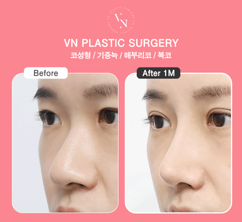 VN Plastic Surgery Real Model Recruitment & Application Method image 7