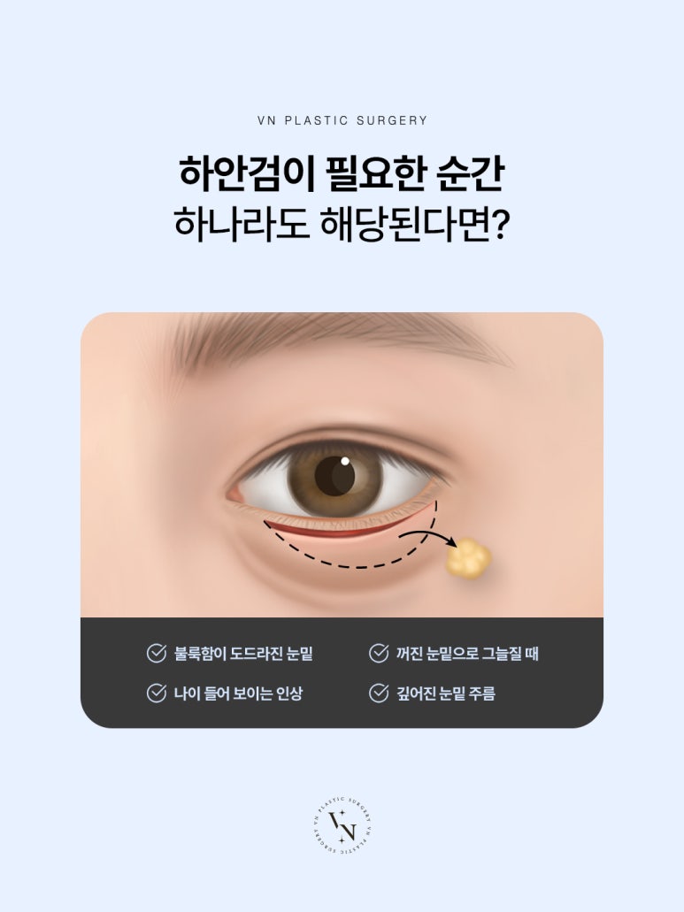 눈밑 처짐을 개선하는 신논현 브이엔성형외과 하안검수술 관련 이미지 3