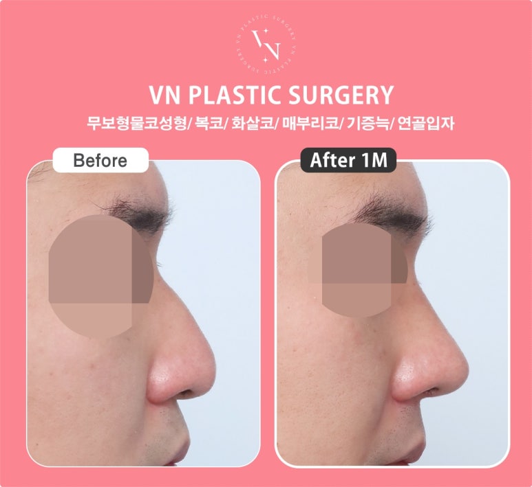 Why Does the Cost of Hump Nose Surgery Vary by Clinic? 5 Reasons for the Price Difference image 8