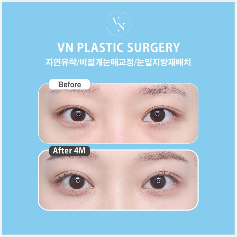 Best Place for Lower Eyelid Fat Repositioning: Should You Always Remove Lower Eyelid Fat? image 6