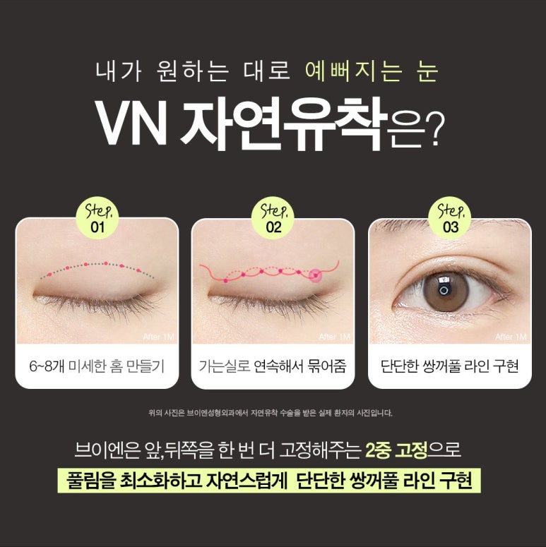 수험생만을 위한 특별한 눈성형 혜택, [브이엔성형외과, 수능눈성형] 관련 이미지 4