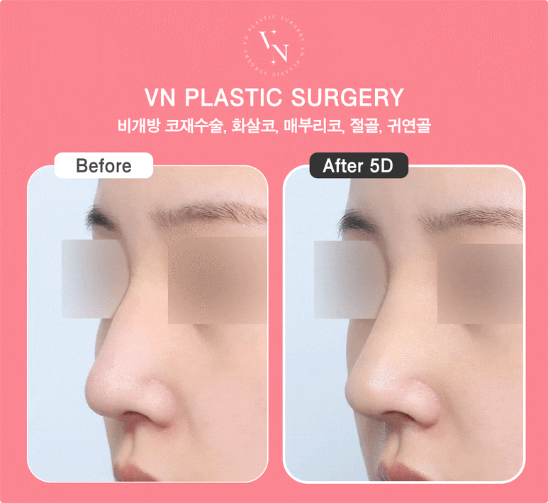 Why Does the Cost of Hump Nose Surgery Vary by Clinic? 5 Reasons for the Price Difference image 5