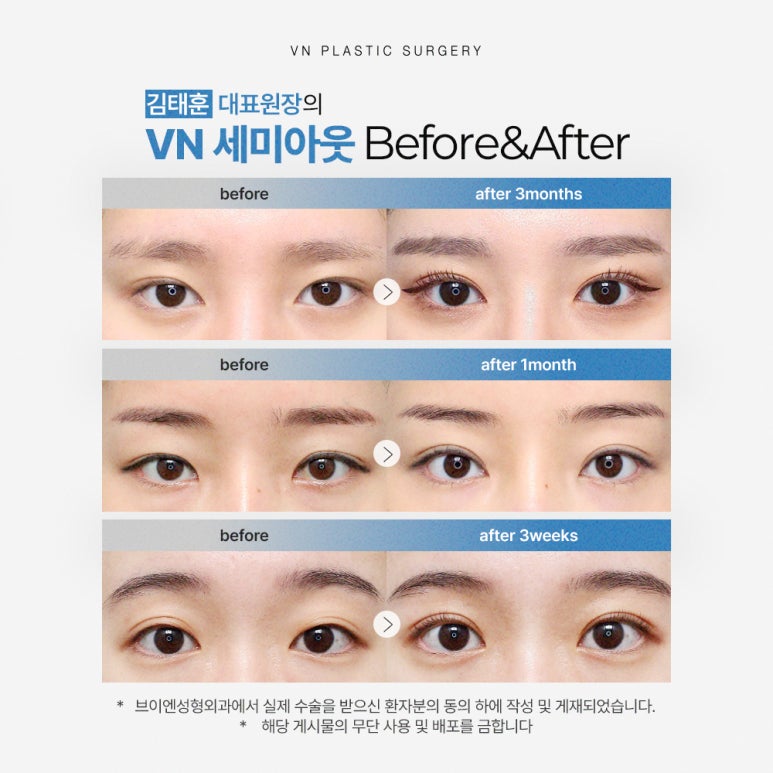 [강남/신논현 브이엔성형외과] 수험생쌍꺼풀수술, 자연스럽게 예뻐지는 가장 확실한 방법 관련 이미지 3