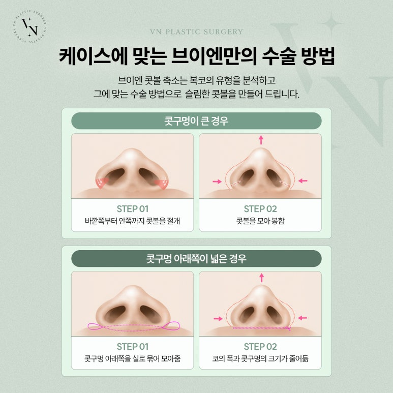 VN Plastic Surgery: Want a sharper nasal tip? Bulbous nose correction image 4