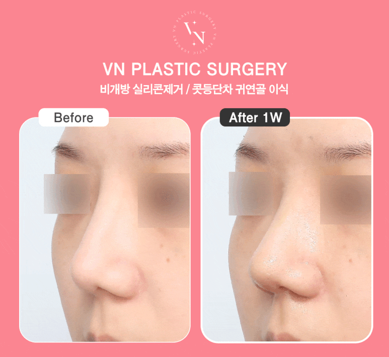 Restoring a Natural Look with Closed Nasal Implant Removal, VN Plastic Surgery image 7