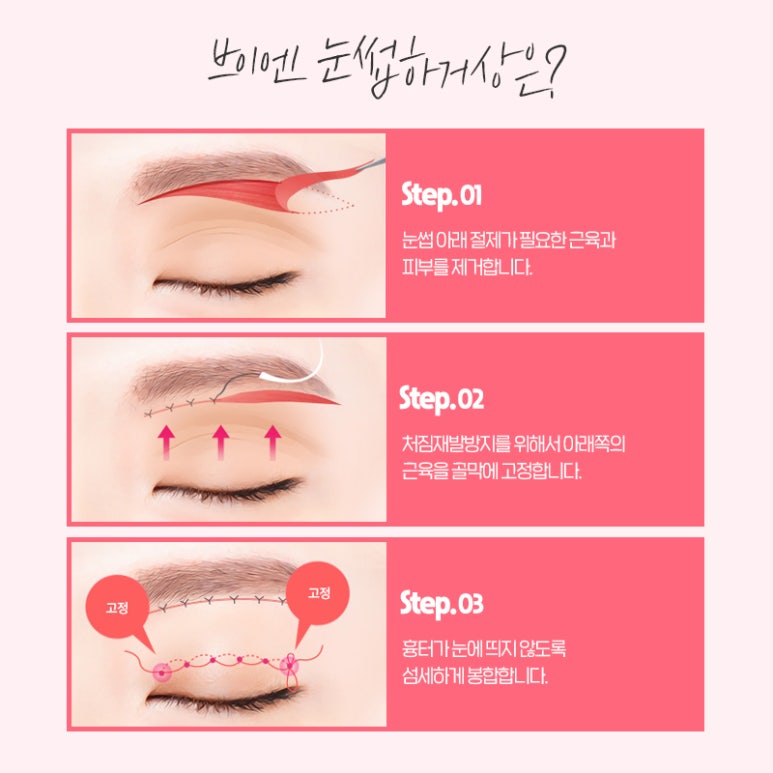 대표적인 중년눈성형 알아보기 I 브이엔성형외과 관련 이미지 5