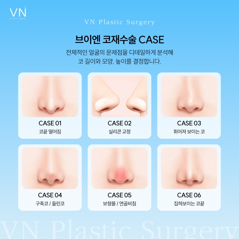 What Is the Right Time for Revision Rhinoplasty? image 3