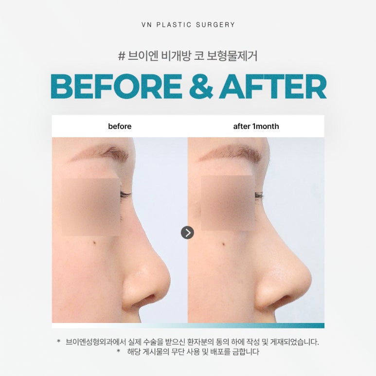 Restoring a Natural Look with Closed Nasal Implant Removal, VN Plastic Surgery image 2