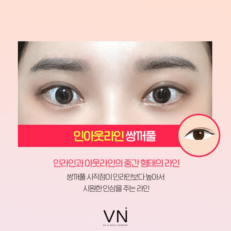 인라인? 아웃라인? 쌍꺼풀수술라인 종류 알아보기 (+연예인 쌍꺼풀) 관련 이미지 4