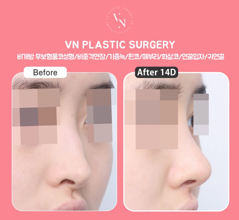 Thinking About Non-Open Nose Surgery? Find the Answer with ShashaKo at VN Plastic Surgery image 5