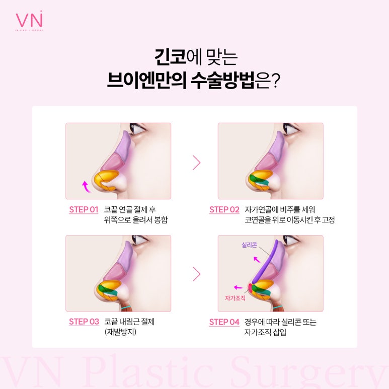유형별로 알아보는 코수술, 나는 어떤 유형일까? 관련 이미지 4