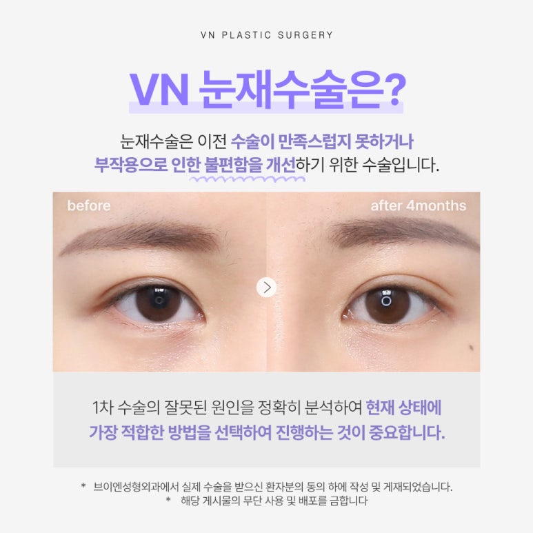 눈재수술, 브이엔성형외과에서 세심함으로 다시 완성💜✨ 관련 이미지 2