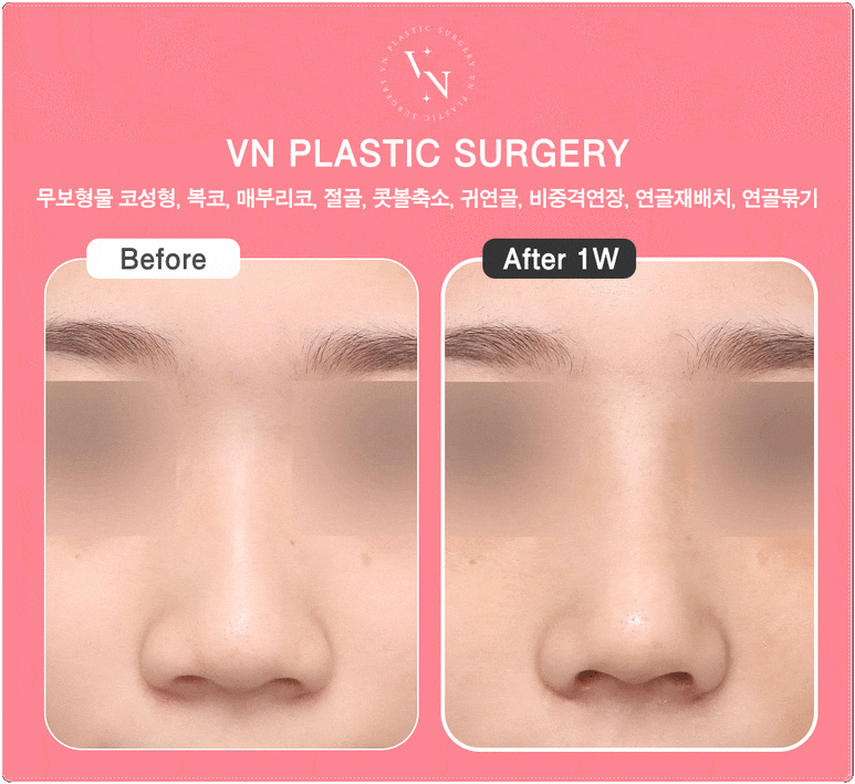 Why the Tip of the Nose Looks Blunt and Large: VN Plastic Surgery’s Bulbous Nose Surgery image 5