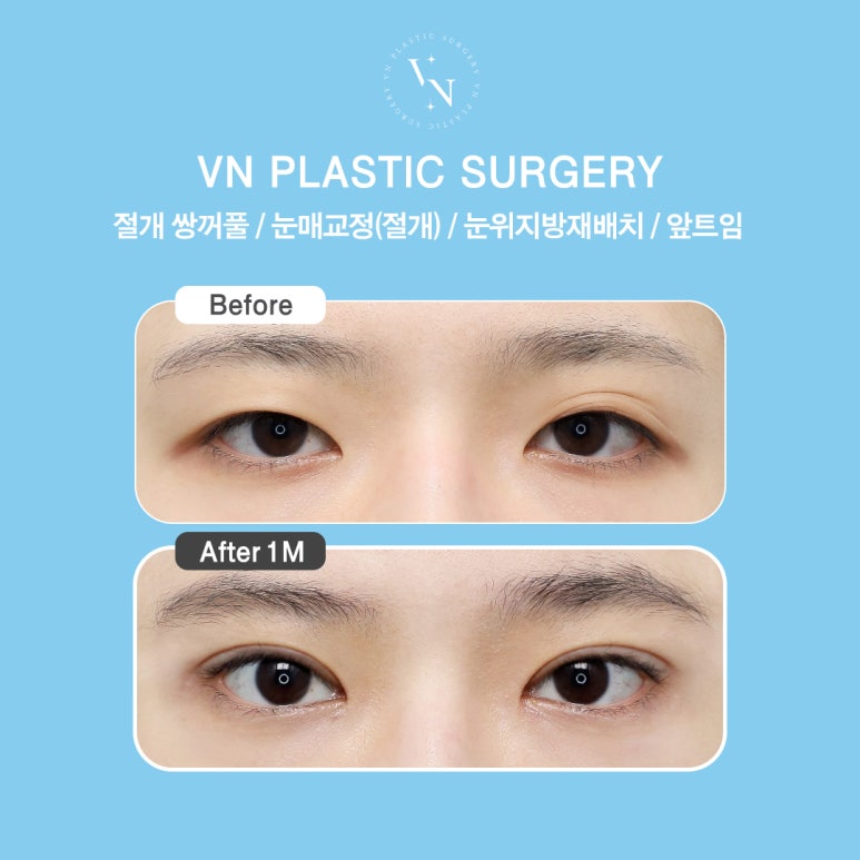 [Gangnam/Sinnonhyeon VN Plastic Surgery] Post-College Entrance Exam Double Eyelids Surgery Is Timed Perfectly Now! image 5