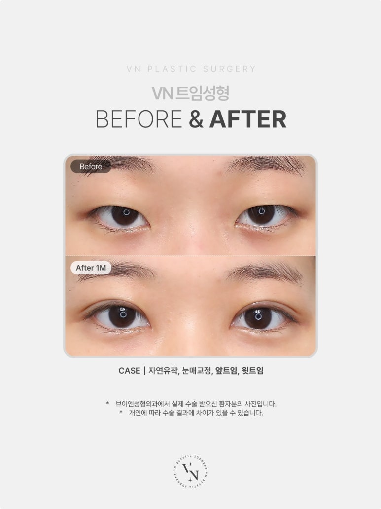 앞트임 윗트임 차이, 같은 트임성형인데 뭐가 다를까? 관련 이미지 3