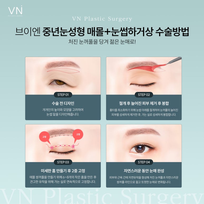 중년눈 성형 고민하고 있다면? 관련 이미지 4